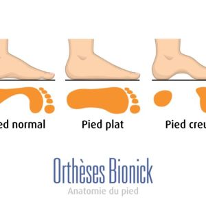 Anatomie d'un pied normal vs pied plat (appuie partout au sol) ou pied creux (appuie avant-pied et talon)