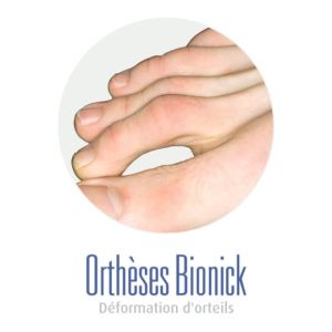 Orteils marteaux (un plat sous l'orteil comme un marteau) Orteils en griffe (comme un oiseau, qui se tient sur une branche)