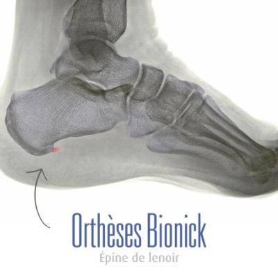 Épine de lenoir sous le calcanéum