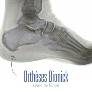 Épine de lenoir sous le calcanéum
