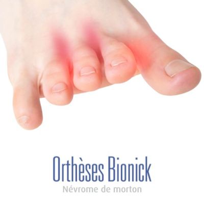 Nevrome_de_morton_pathologie_bionick (Demo)