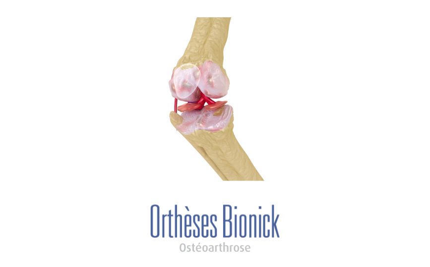 Osthéoarthrose d'un genou