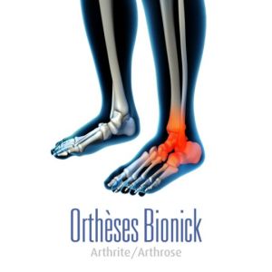 arthrite_arthrose (Demo)