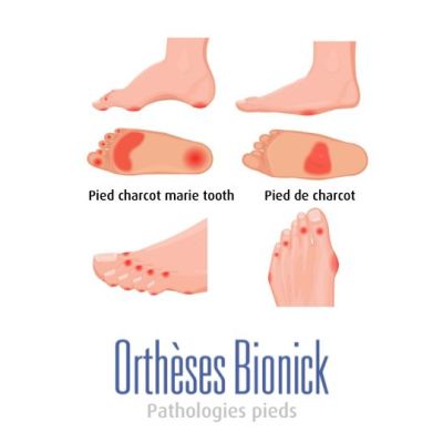 2 types de déformation Charcot.