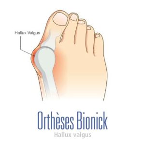 hallux_valgus_deformation_osseuse_bionick (3) (Demo)