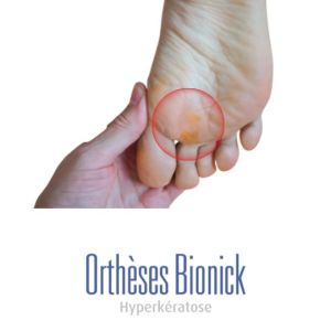 Hyperkératose (corne) sur l'avant-pied