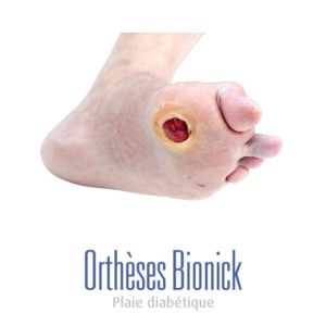 Plaie neuropathique diabétique 1er tête métatarsienne