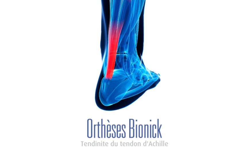 La tendinopathie d’Achille est une irritation du tendon d’Achille. Elle crée une douleur et parfois une enflure au niveau du tendon près du talon. La blessure peut être située soit à l’insertion sur le talon ou au centre du tendon.